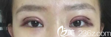 剛做完全切雙眼皮即刻的照片 剛做完全切雙眼皮即刻的照片