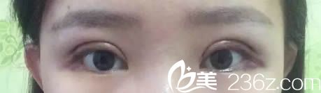 切開(kāi)雙眼皮術(shù)后第3天恢復(fù)效果 切開(kāi)雙眼皮術(shù)后第3天恢復(fù)效果