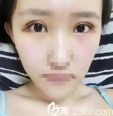 全切雙眼皮7天拆線后的美照 全切雙眼皮7天拆線后的美照