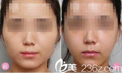 大同清木整形姜際珠瘦臉案例 大同清木整形姜際珠瘦臉案例