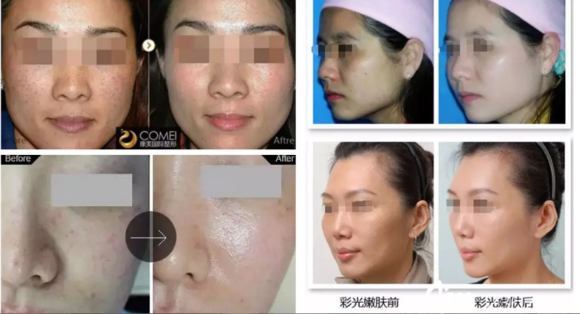 秦琴醫(yī)生整形案例