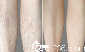 大同清木整形宋瑩潔激光脫毛案例 大同清木整形宋瑩潔激光脫毛案例