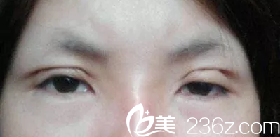 雙眼皮手術(shù)失敗