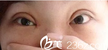 哪些雙眼皮需要修復(fù)