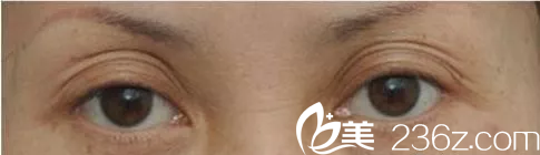 雙眼皮修復(fù)手術(shù)難嗎