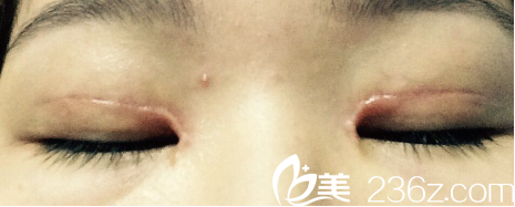 雙眼皮手術(shù)的疤痕程度影響修復(fù)