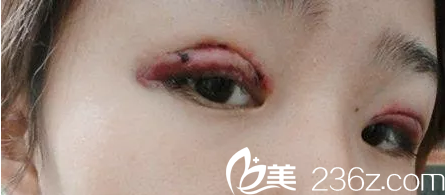 什么樣的雙眼皮算失敗