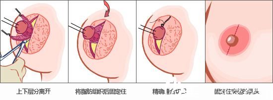 乳頭乳暈整形術(shù)
