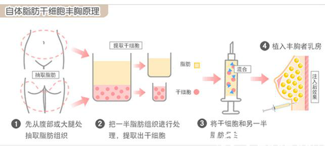 自體脂肪豐胸原理圖