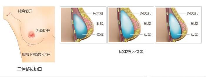 假體隆胸術(shù)