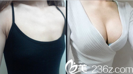 隆胸前后對(duì)比圖