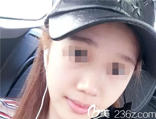 韓國will醫(yī)院隆鼻前的樣子 韓國will醫(yī)院隆鼻前的樣子