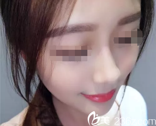 will醫(yī)院魏亨坤做鼻整形怎么樣？揭秘真實(shí)隆鼻案例