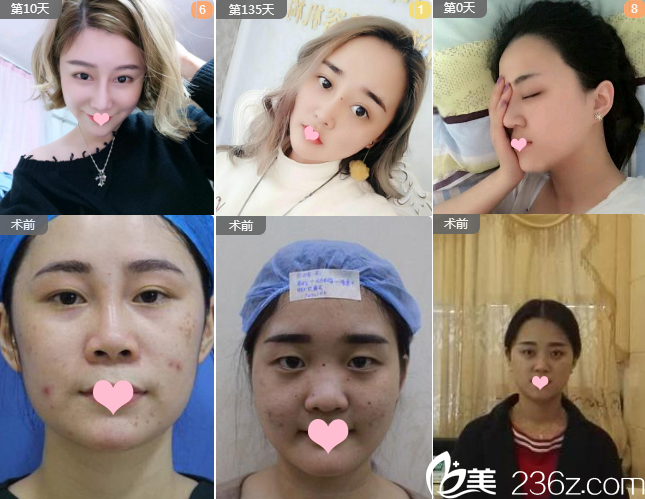 佛山夢(mèng)露整形美容醫(yī)院游萬(wàn)福院長(zhǎng)隆鼻案例 佛山夢(mèng)露整形美容醫(yī)院游萬(wàn)福院長(zhǎng)隆鼻案例