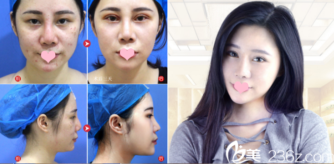 佛山夢(mèng)露整形醫(yī)院孫文娜雙眼皮和隆鼻案例 佛山夢(mèng)露整形醫(yī)院孫文娜雙眼皮和隆鼻案例