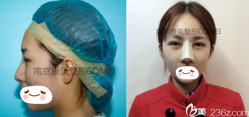 鼻綜合術(shù)前及術(shù)后即刻效果對比