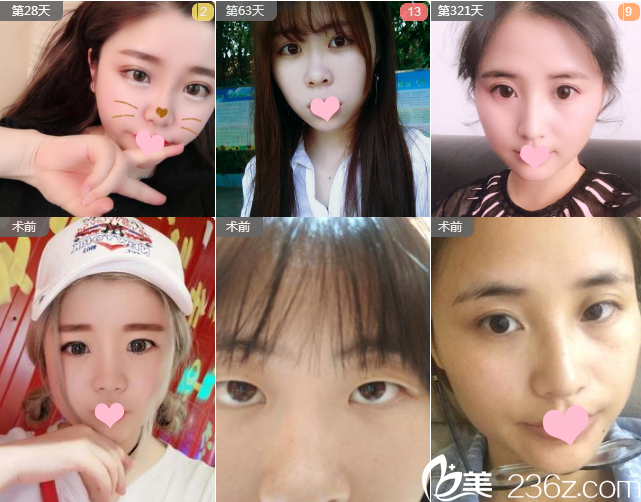 佛山夢(mèng)露整形醫(yī)院孫文娜雙眼皮案例 佛山夢(mèng)露整形醫(yī)院孫文娜雙眼皮案例