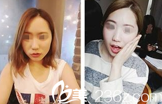 大同清木隆鼻案例術前 大同清木隆鼻案例術前