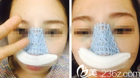 鼻綜合手術即可效果大同清木 鼻綜合手術即可效果大同清木