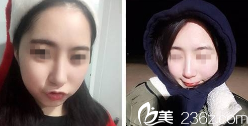 大同清木鼻綜合整形術后5個月圖 大同清木鼻綜合整形術后5個月圖