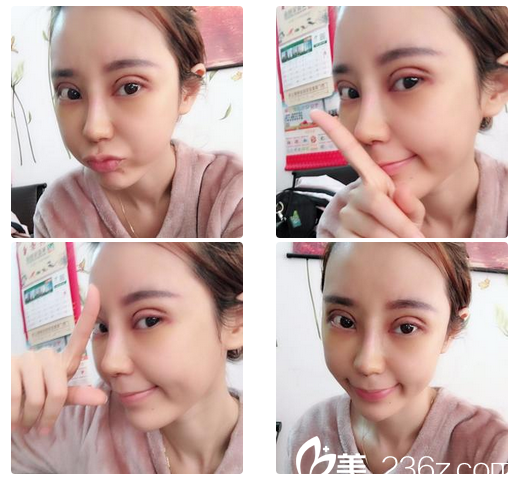 看佛山夢露整形醫(yī)院游萬福醫(yī)生為我做的雙眼皮和隆鼻效果怎么樣