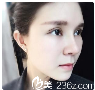 術(shù)后側(cè)面自拍