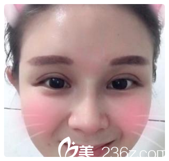 雙眼皮開內(nèi)眼角第九天<span style=