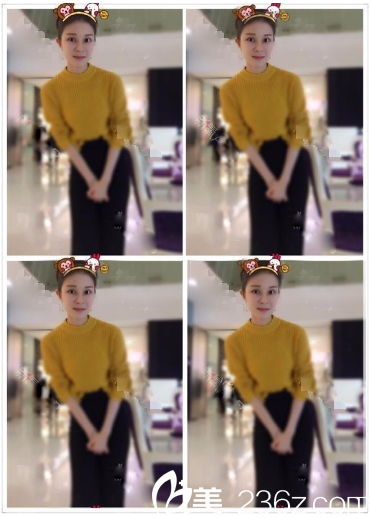 雙眼皮隆鼻術(shù)后一個(gè)月自拍