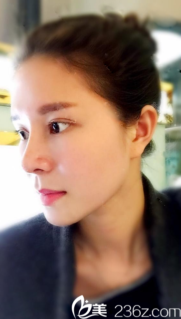 深圳雅涵高山做鼻子怎么樣？分享深圳隆鼻大王高山鼻綜合案例圖片