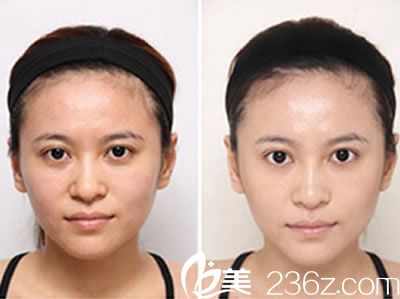 秦瑞醫(yī)生的光子嫩膚案例 秦瑞醫(yī)生的光子嫩膚案例