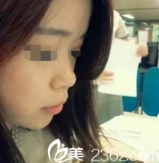 矮塌鼻子需要隆鼻 矮塌鼻子需要隆鼻