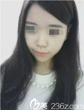 隆鼻手術(shù)術(shù)前照片 隆鼻手術(shù)術(shù)前照片