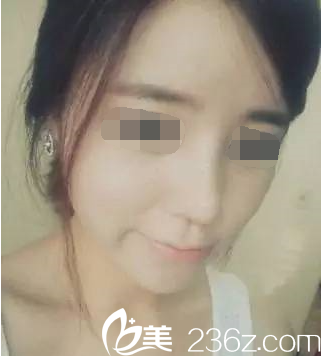 韓國(guó)will整形外科醫(yī)院做鼻子效果好嗎？真人案例隆鼻日記