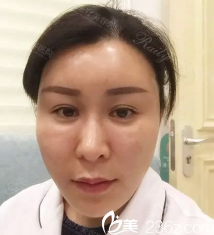 35歲張姐做自體脂肪填充10天<span style=