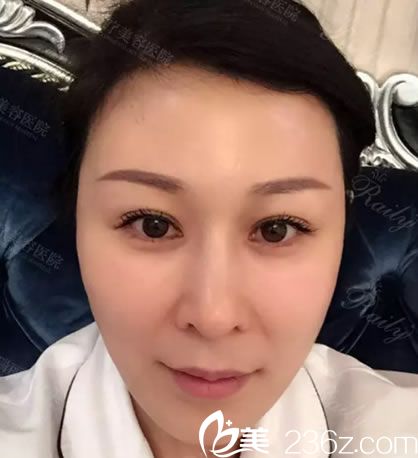 杭州瑞麗做脂肪填充面部20天<span style=