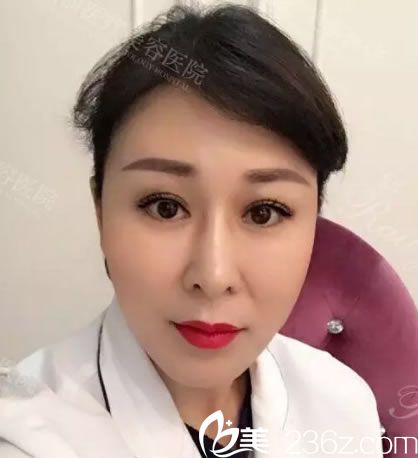 自體脂肪填充心形臉第30天<span style=