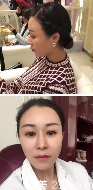 自體脂肪填充心形臉9個(gè)月<span style=