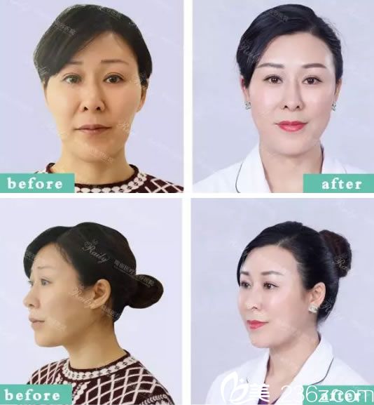 杭州瑞麗整形自體脂肪填充<span style=