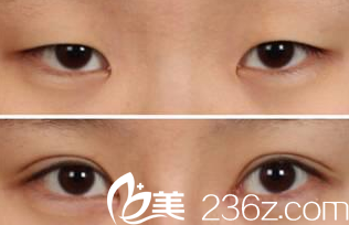 大同美神整形王賀宇雙眼皮案例 大同美神整形王賀宇雙眼皮案例