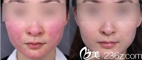 大同美神整形孟慶蘭祛紅血絲案例 大同美神整形孟慶蘭祛紅血絲案例