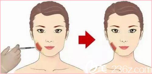 漯河締美儷打瘦臉 漯河締美儷打瘦臉