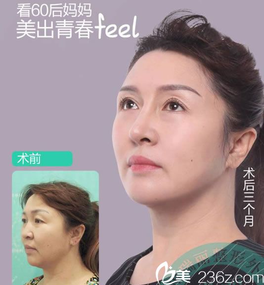 60后媽媽做自體脂肪填充效果