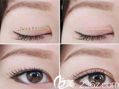 埋線法手術(shù)效果