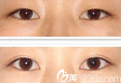 切開法雙眼皮手術(shù)前后對比