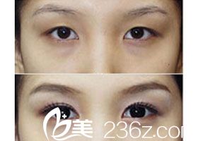 韓式雙眼皮手術(shù)前后對比