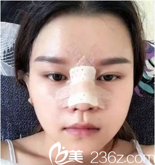 魏亨坤院長鼻綜合手術