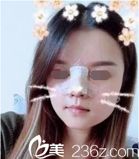 韓國鼻綜合真人案例