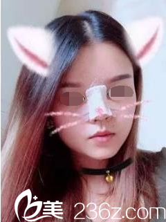 韓國will醫(yī)院假體加自體鼻綜合