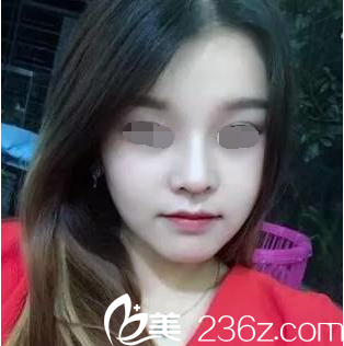 韓國(guó)will醫(yī)院假體加自體鼻綜合真人案例分享