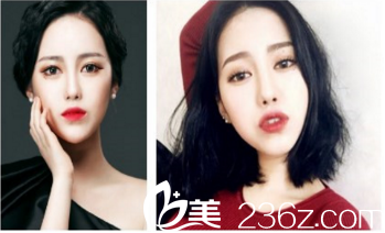 德州友誼醫(yī)院杜太超做雙眼皮怎么樣？多少錢？真人案例分析